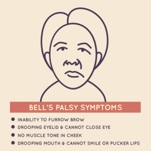 facial paralysis