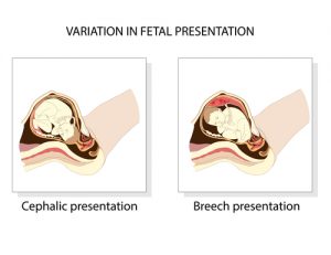 breech birth