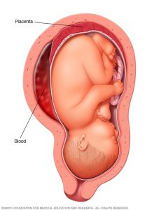 placental abruption condition