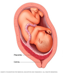 placenta previa condition