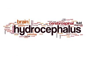 hydrocephalus birth injury attorney