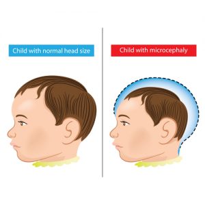 Microcephaly neurodevelopmental disorder